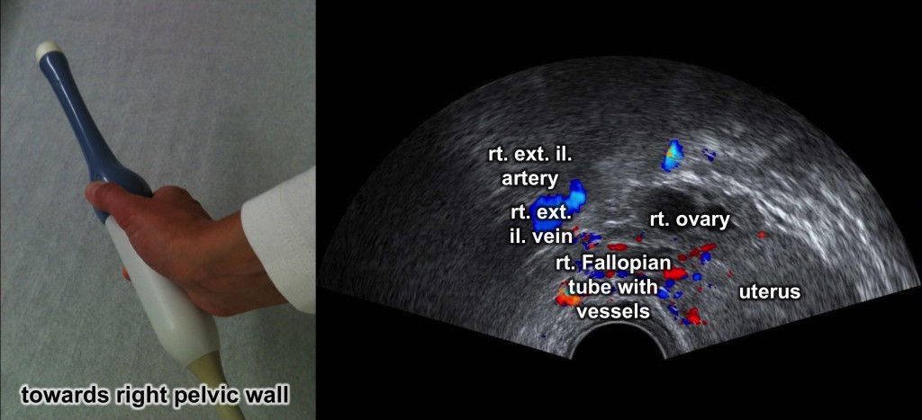 Fallopian-Doppler